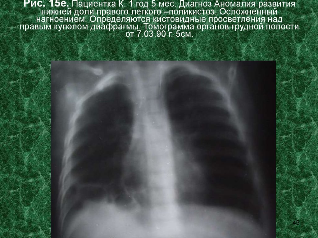 Диагноз аномалия. Синдром средней доли рентген. Е15 диагноз. Синдром средней доли правого легкого. Аномалии в доли правого легкого.