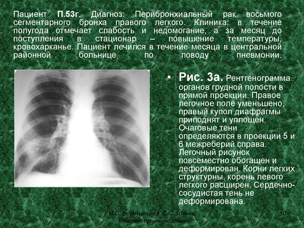 Усилен легочный рисунок в прикорневых зонах что это