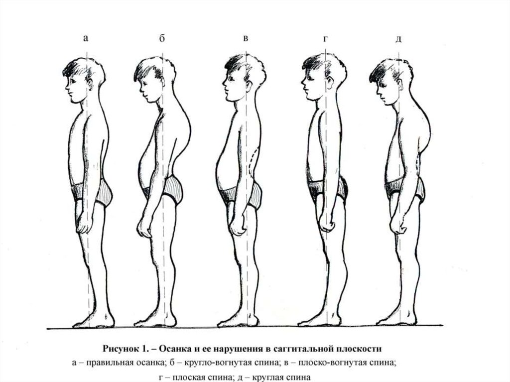 Рисунок осанки человека. Тип осанки сагиттальная плоскость. Типы осанки кругловогнутая. Круглая плоская спина. Типы нарушения осанки.