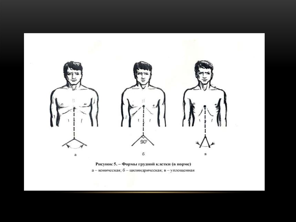 Формы грудной клетки