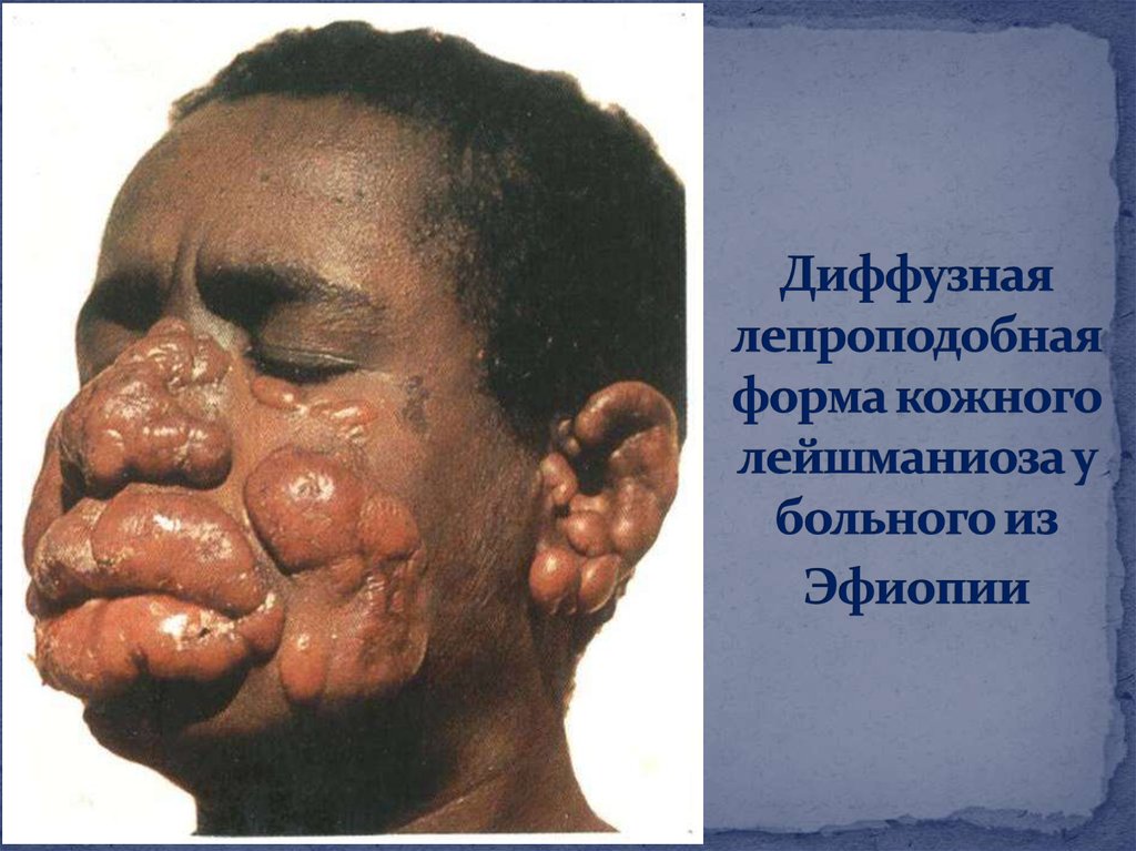 Диффузная лепроподобная форма кожного лейшманиоза у больного из Эфиопии