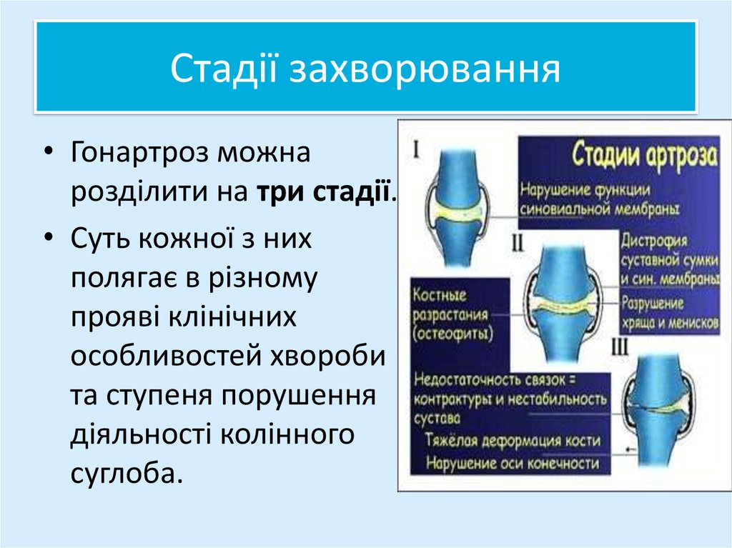 Презентация на тему артроз