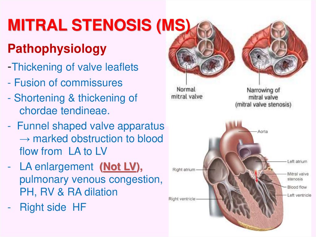 Chronic Rheumatic Heart Disease - online presentation