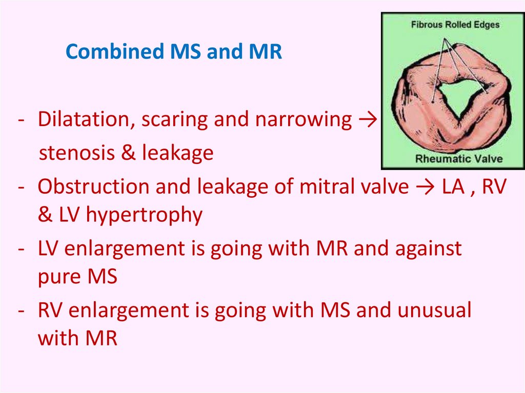 Chronic Rheumatic Heart Disease Symptoms