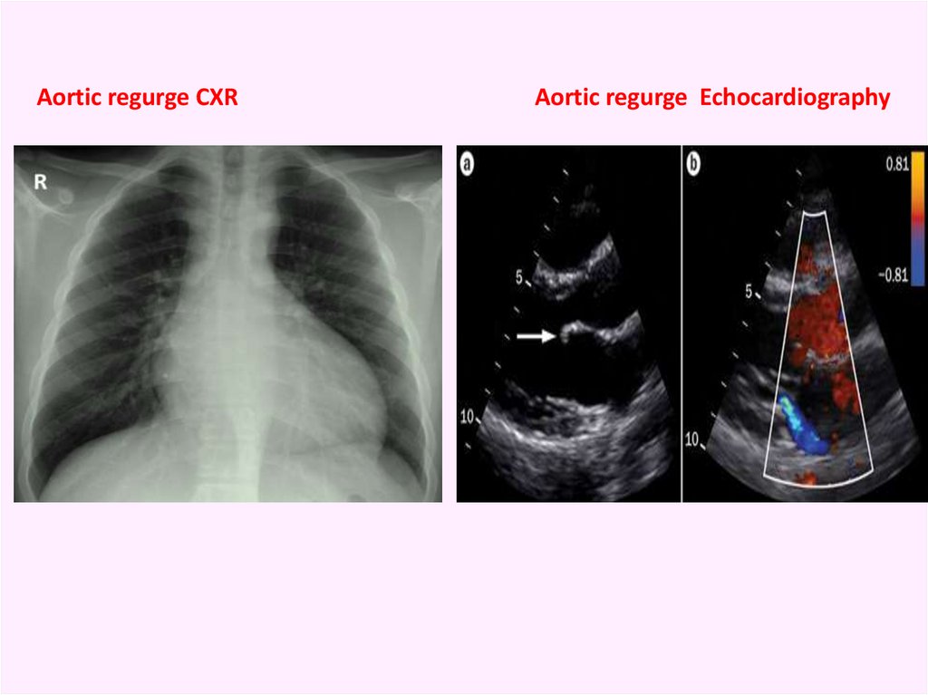 chronic-rheumatic-heart-disease