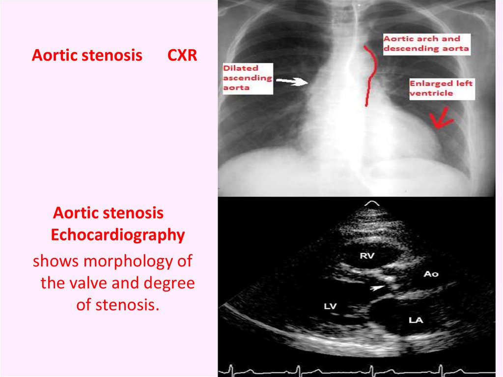 chronic-rheumatic-heart-disease