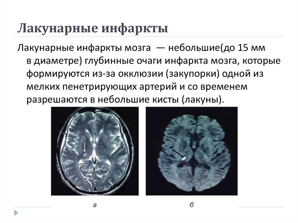 Постишемические изменения мозга