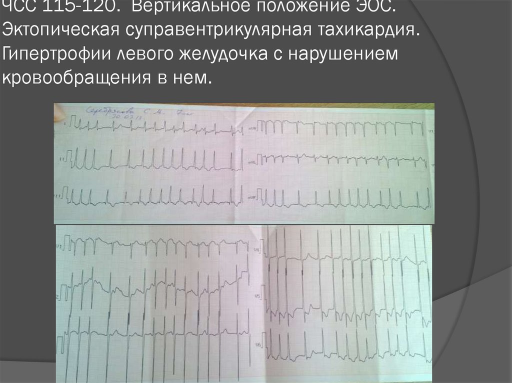 Вертикальное положение эос. Синусовый ритм вертикальная ЭОС. ЭКГ вертикальное положение. Вертикальное положение электрической оси. Электрическая ось вертикальная ЭКГ.