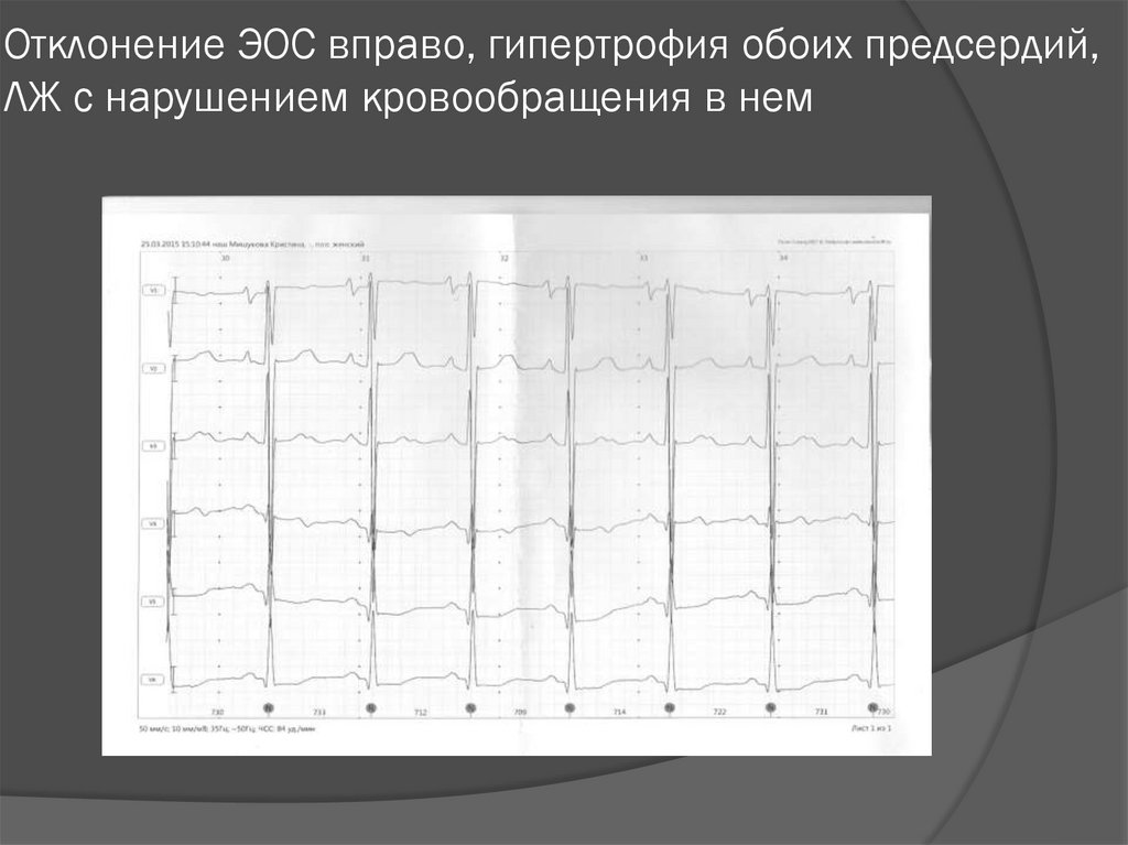 Эос гипертрофия. ЭОС И гипертрофия.