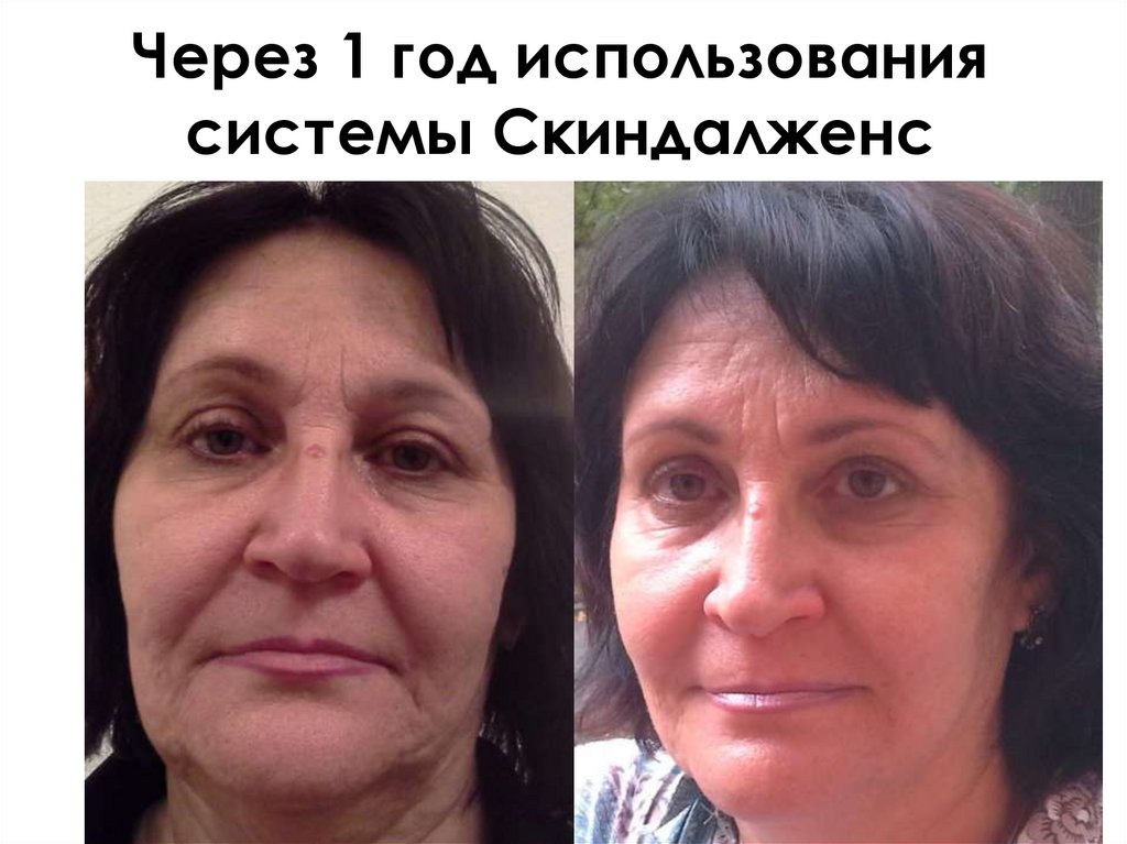 Через 1 год использования системы Скиндалженс