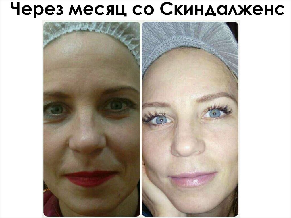 Через месяц со Скиндалженс