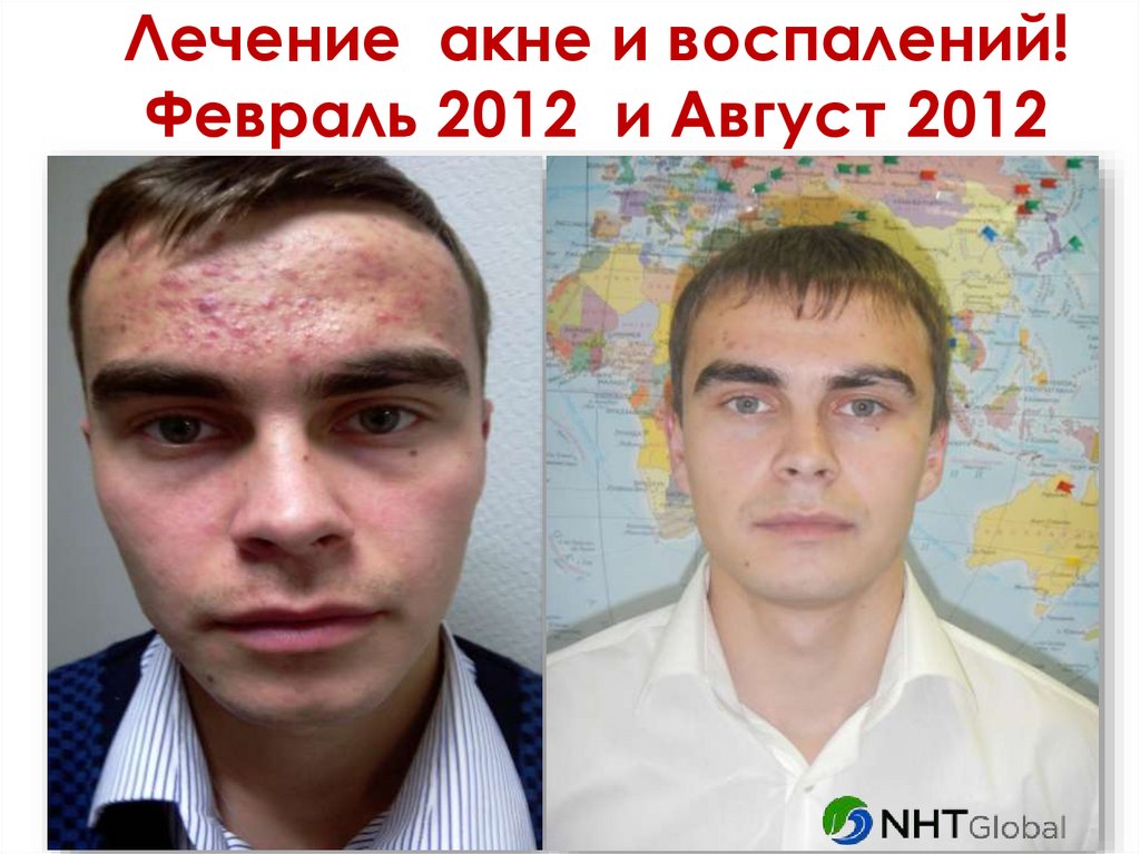Лечение акне и воспалений! Февраль 2012 и Август 2012