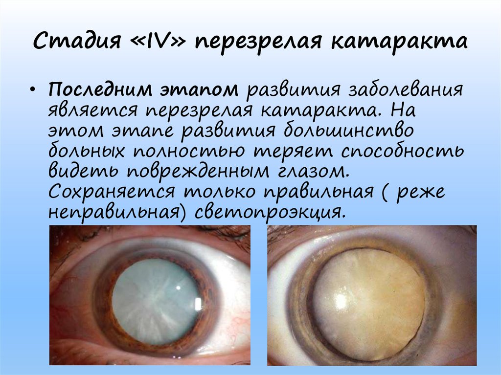 Начальная старческая катаракта. Передне капсулярная катаракта. Капсулярная врожденная катаракта. Сенильная катаракта стадии.