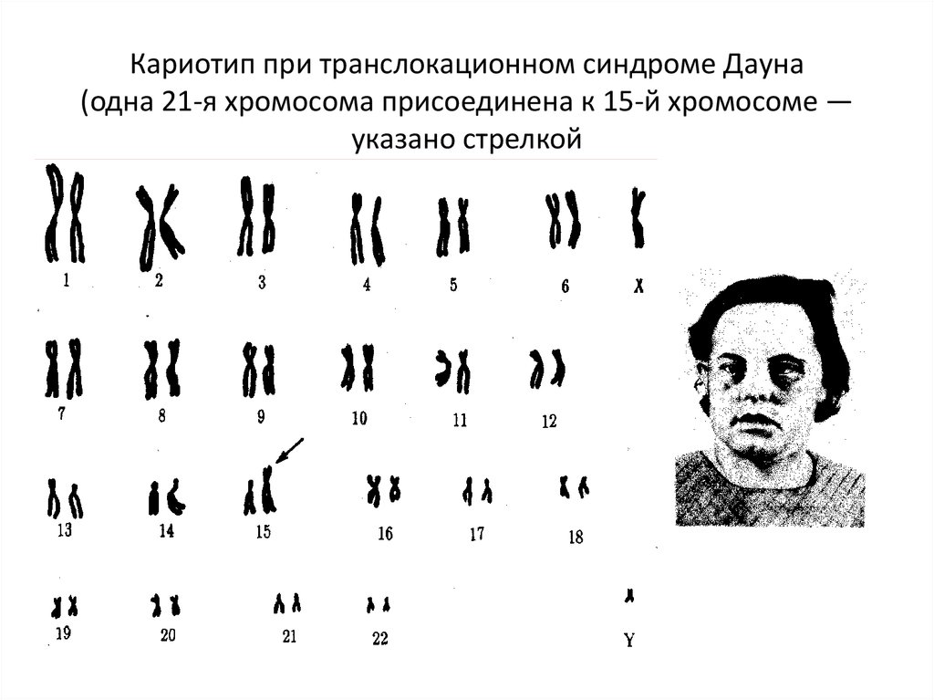Кариотип при транслокационном синдроме Дауна (одна 21-я хромосома присоединена к 15-й хромосоме — указано стрелкой