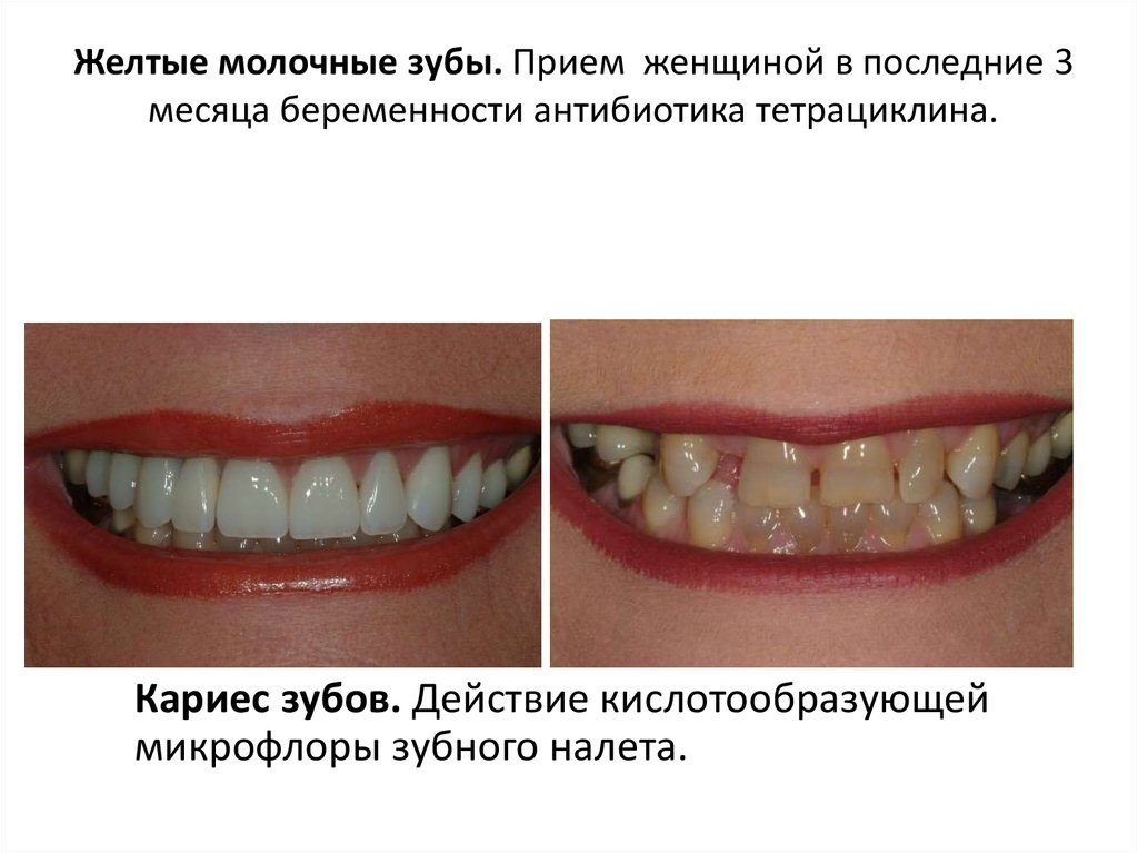 Желтые молочные зубы. Прием женщиной в последние 3 месяца беременности антибиотика тетрациклина.