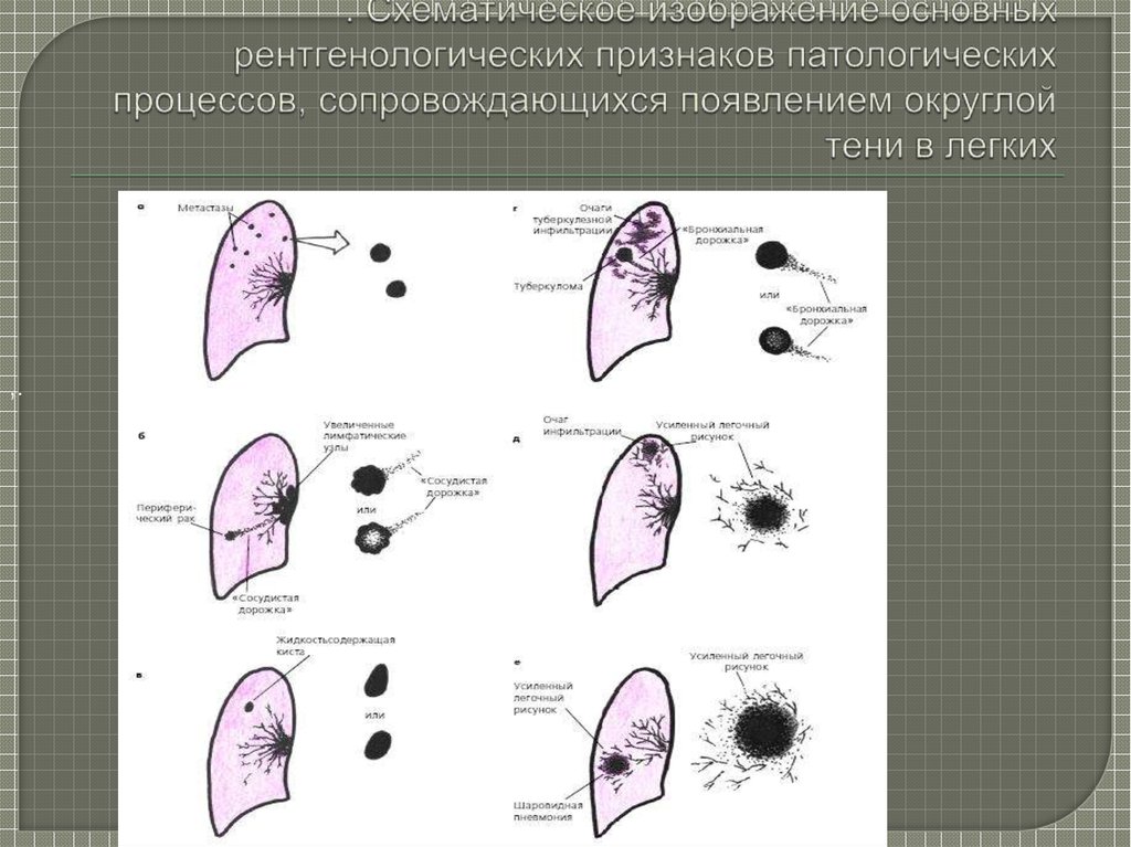 Легкое процесс. Рентгенологические изменения синдром круглой тени. Синдром круглой тени патологии легочной ткани. Округлая тень в легком рентгенологический признак. Синдром круглой тени на рентгенограмме легких.