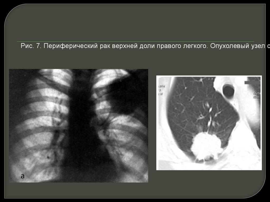 Периферический рак. Периферический CR верхней доли левого легкого. Периферическое объёмное образование средней доли правого легкого. Перифирический очаг верхней доли правого легкого. Периферический тумор верхней доли правого легкого.