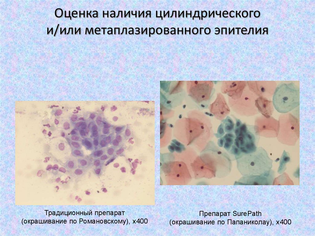 Клетки метаплазированного эпителия с реактивными изменениями