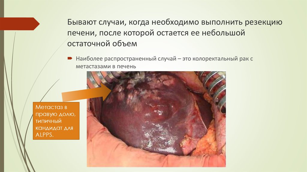 Бывают случаи, когда необходимо выполнить резекцию печени, после которой остается ее небольшой остаточной объем