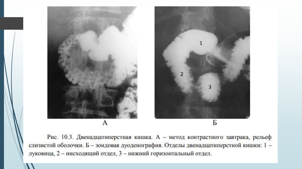Рентгенологическое исследование тонкой кишки. Рентгенологическое исследование тонкого кишечника. Методы исследования тонкой кишки. Перфорация желудка рентген.
