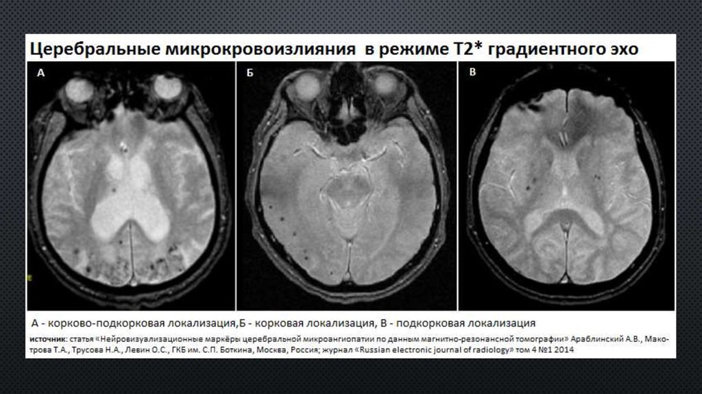 Микроангиопатия головного мозга fazekas