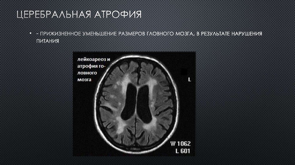 Атрофия полушарий. Атрофия головного мозга на кт. Церебральная кортикальная атрофия степени. Атрофические изменения головного мозга кт.