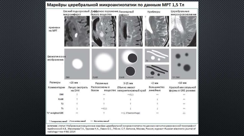 Микроангиопатия мозга