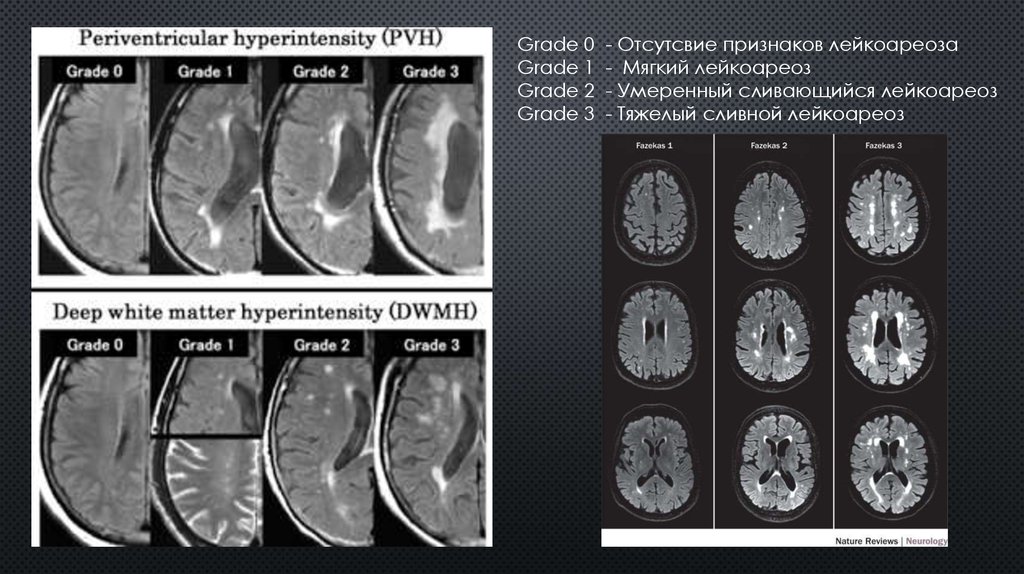 Картина церебральной микроангиопатии что это - 94 фото