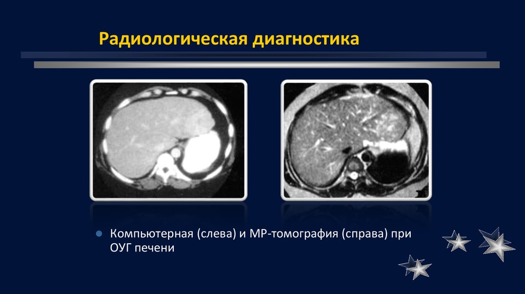 Радиологическая диагностика. Очаговые заболевания печени. Очаговая Узловая гиперплазия печени на мрт. Узловая (очаговая) гиперплазия печени является.