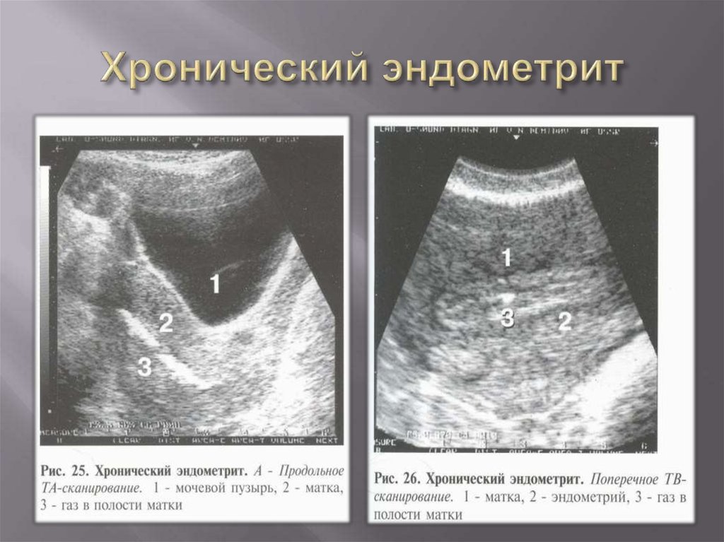 Узи признаки эндометриоза матки. Острый послеродовой эндометрит. Послеродовый эндометрит УЗИ. Хронический эндометрит УЗИ.