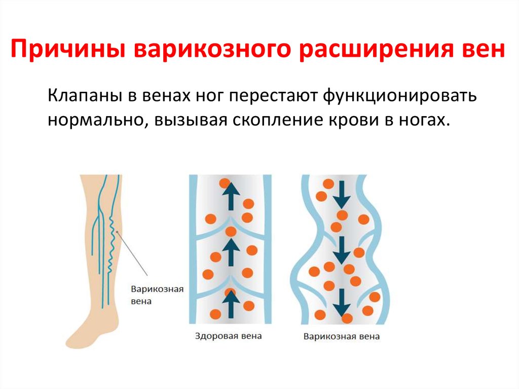 Варикоз корнилова схема