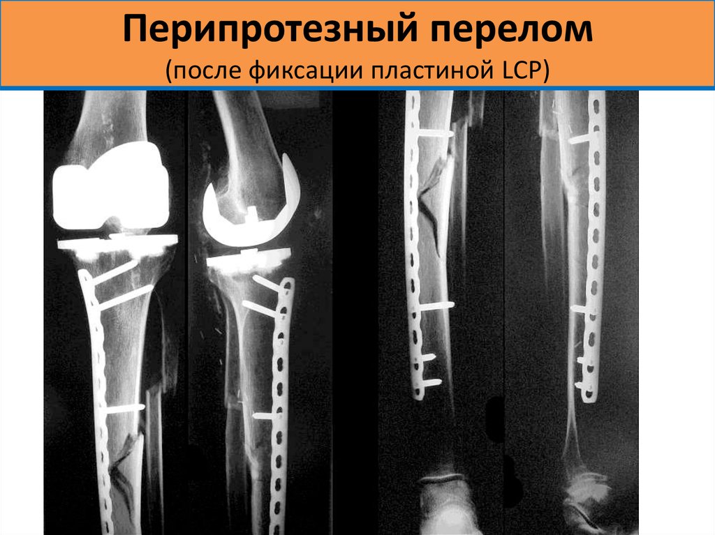 После перелома. Перипротезный перелом бедренной кости остеосинтез. Перипротезный перелом тазобедренного сустава. Классификация Ванкувер Перипротезные переломы. Несросшийся перелом большеберцовой кости.