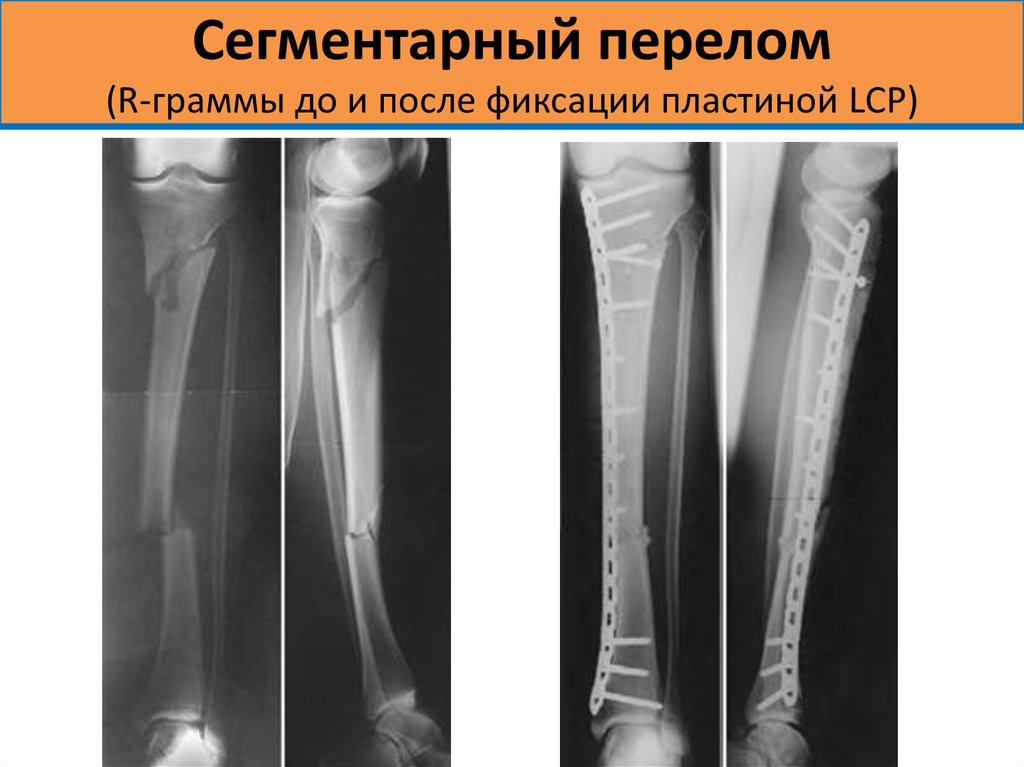 3 оскольчатый перелом