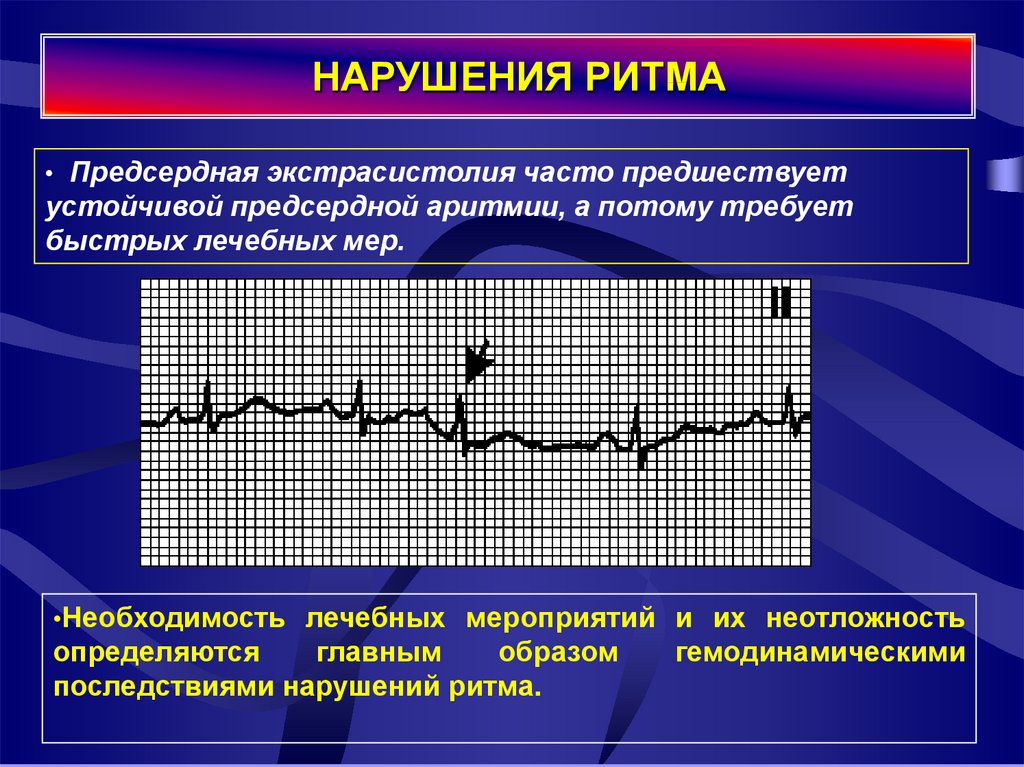 Нарушения ритма презентация