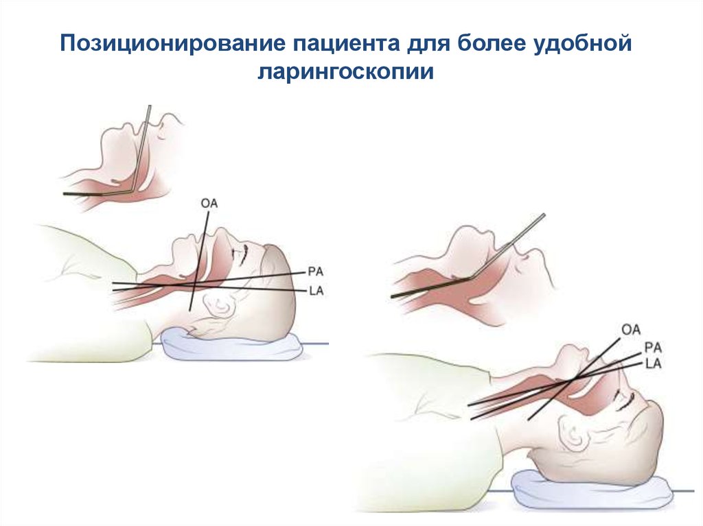 Положение улучшилось. Позиционирование пациента. Улучшенное положение Джексона. Положение головы при интубации трахеи. Интубация Джексона положение.