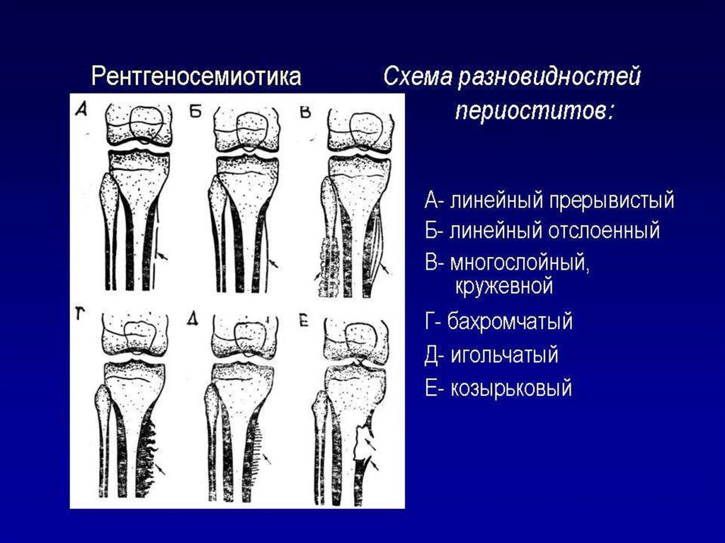 Периостит классификация