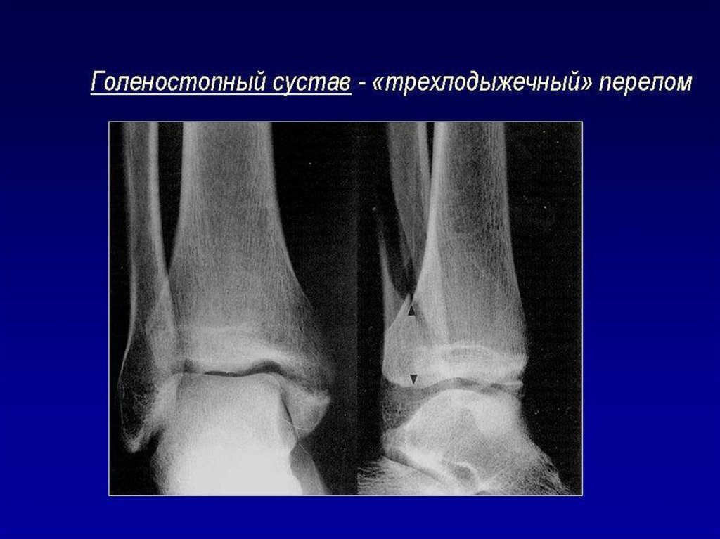 Двухлодыжечный перелом карта вызова скорой медицинской