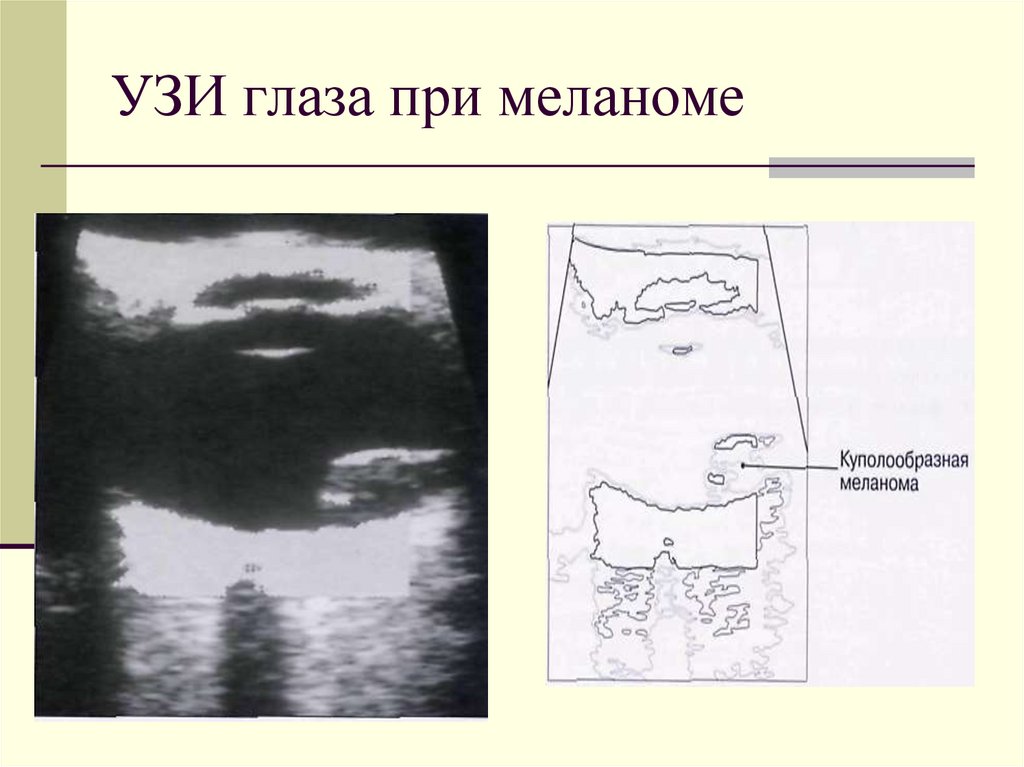 Узи глаза. Эхограмма глаза. Одномерная эхография глаза.