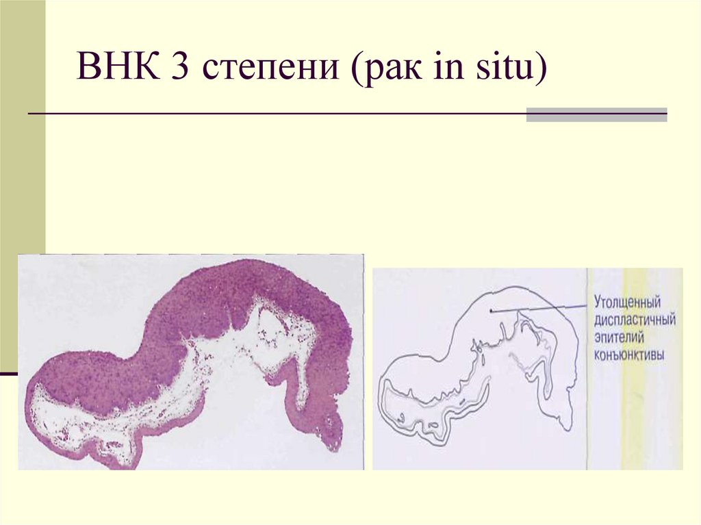 3 стадия рака