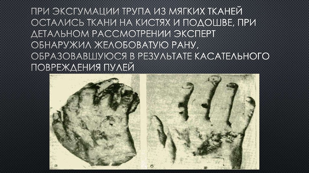 При эксгумации трупа из мягких тканей остались ткани на кистях и подошве, при детальном рассмотрении эксперт обнаружил
