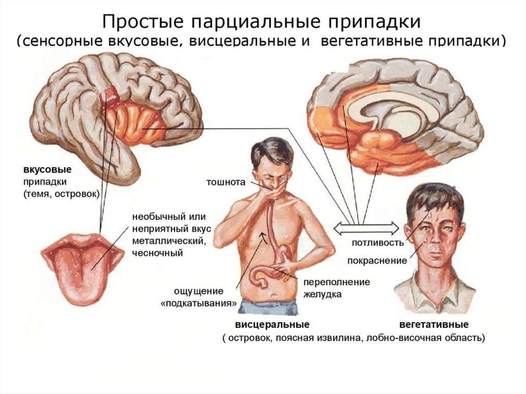 Эпилепсия нервной системы. Парциальные припадки эпилепсии симптомы. Простые парциальные припадки эпилепсии симптомы. Простые парциальные приступы. Простые парциальные припадки сенсорные.