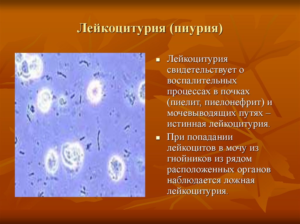 Лейкоциты в моче лейкоцитурия