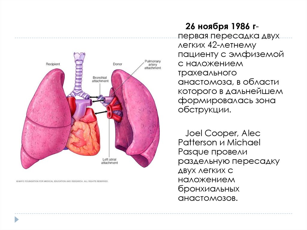 Пересадка легких