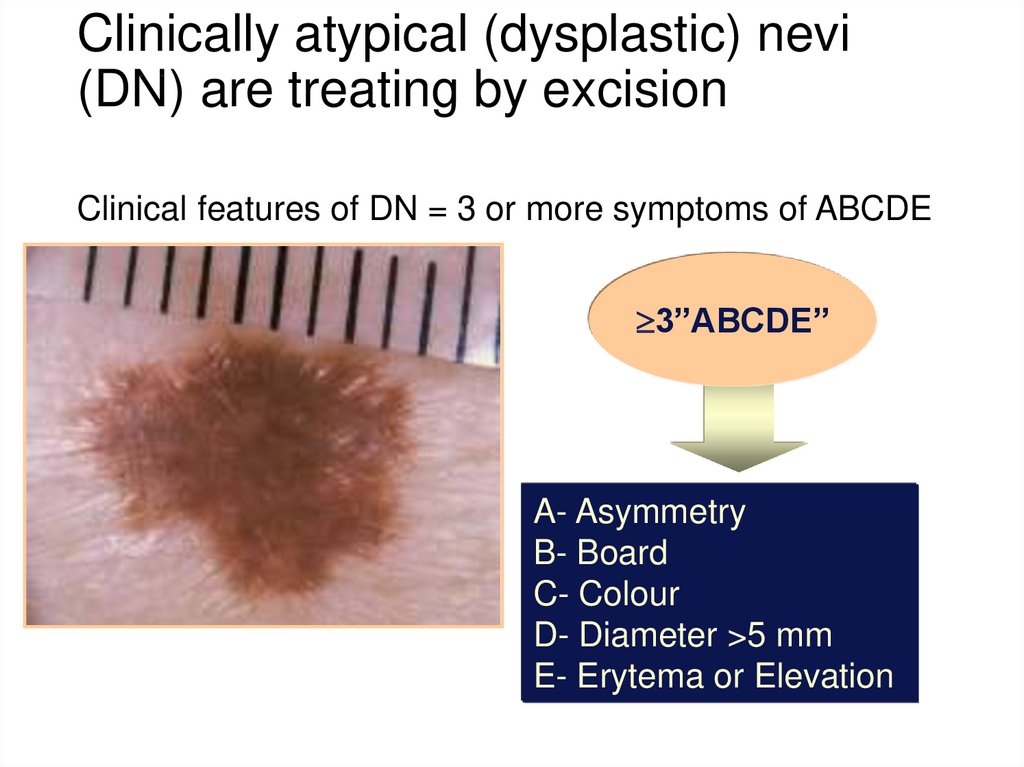 Clinically atypical (dysplastic) nevi (DN) are treating by excision