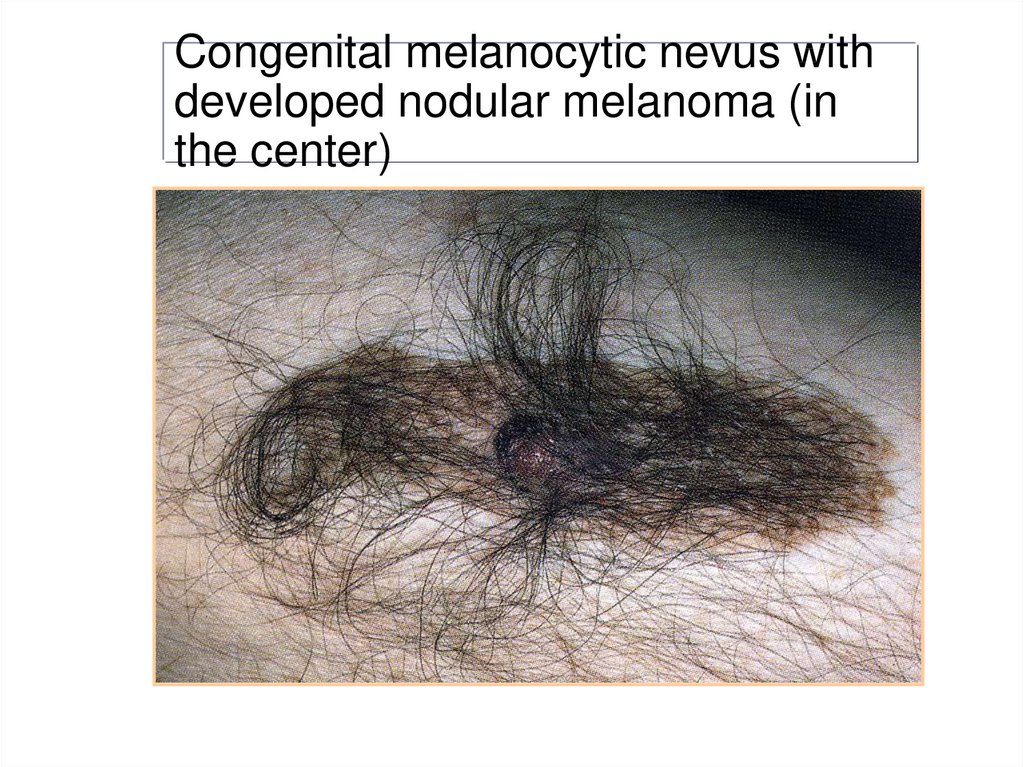 Congenital melanocytic nevus with developed nodular melanoma (in the center)
