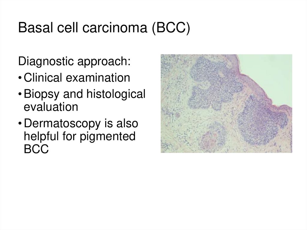 Basal cell carcinoma (BCC)