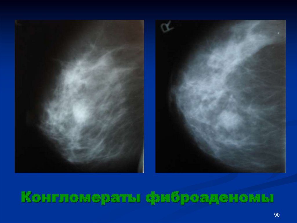 Молочные железы 4а. Распад молочной железы. Распад опухоли молочной железы. Распад опухоли груди фото. Распад опухоли молочной железы фото.