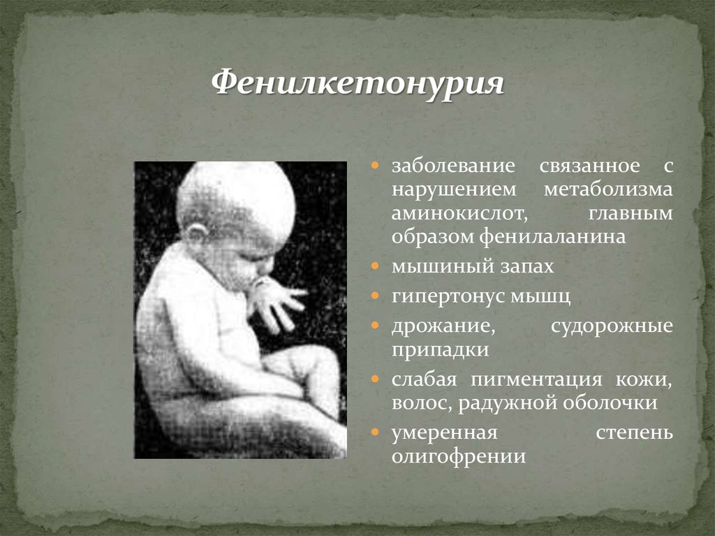 Фенилкетонурия это. Фенил кетон. Заболевание фенилкетонурия. Болезнь фенилкетонурия.