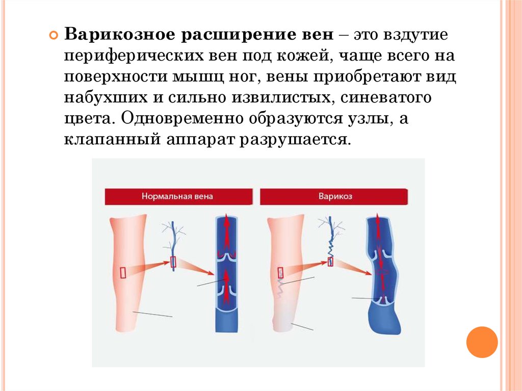 Варикоз корнилова схема