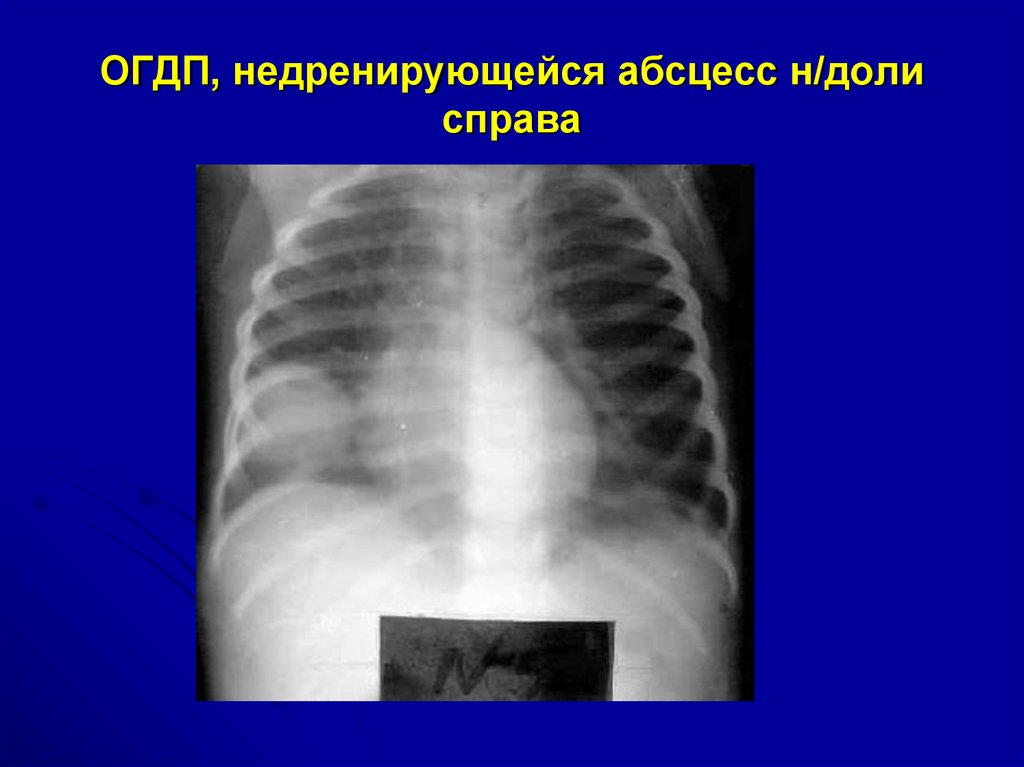 Острая гнойная деструктивная пневмония у детей презентация